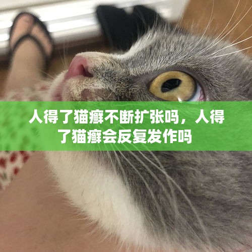 人得了猫癣不断扩张吗，人得了猫癣会反复发作吗 